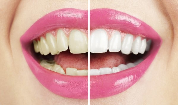 What Makes Ultima White Teeth Whitening Different Guildford