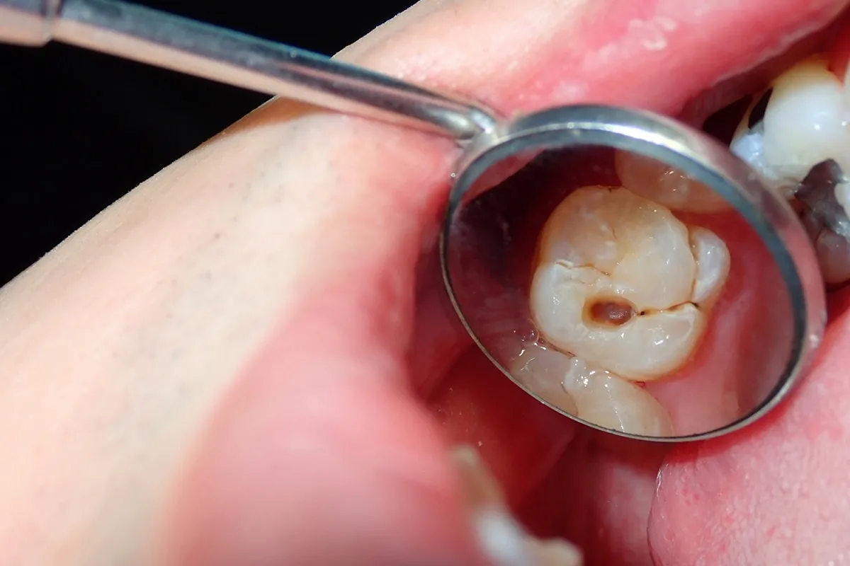 Why Do Teeth Crack? Common Causes to Know Guildford