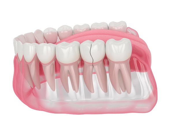 How Can You Manage Pain and Discomfort After a Root Canal Guildford?