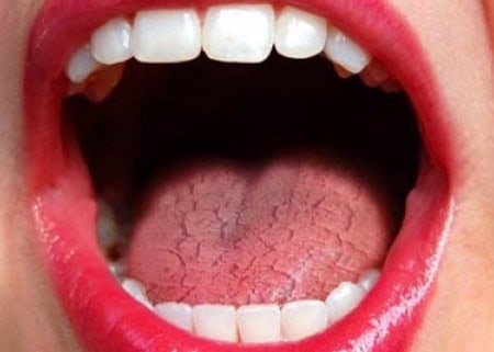 Dry Mouth and Its Role in Tooth Decay Guildford