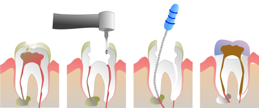 How Do You Properly Care for Your Teeth After a Root Canal Guildford