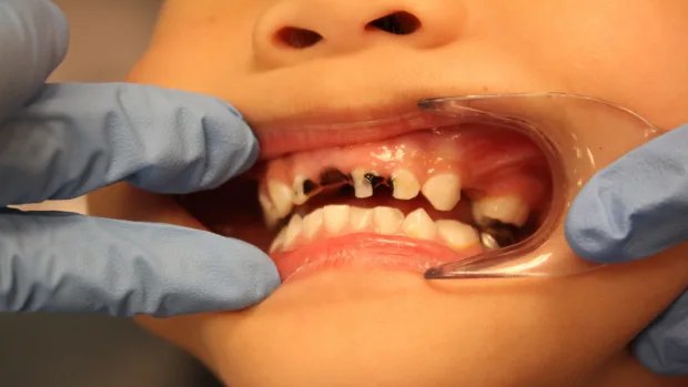 Which Foods and Drinks Cause the Most Damage to Young Smiles Guildford?