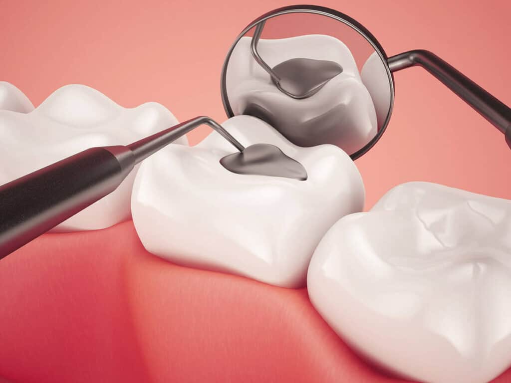 Fighting Cavities and Plaque Buildup Guildford