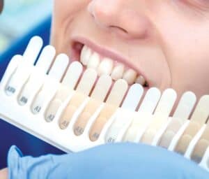 Ultimate Guide to Teeth Whitening with Natural Ingredients Guildford