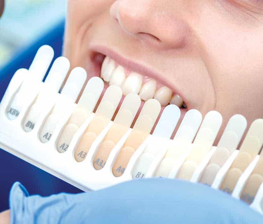 What Happens During Laser Teeth Whitening and How Long the Results Usually Last Guildford