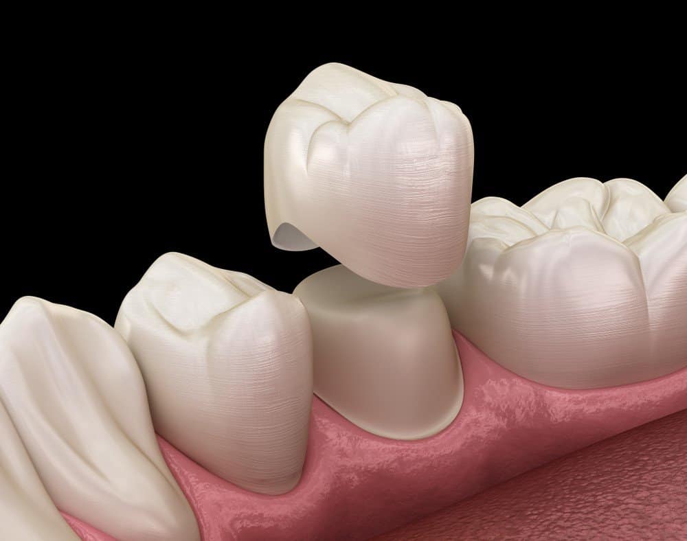 How Can You Prevent Common Dental Crown Problems Guildford?