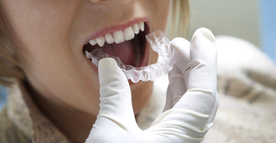 Why Bleaching Trays Require More Time Guildford