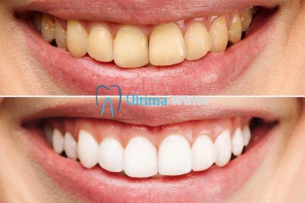 Oral Care Tips for Current and Former Smokers Guildford