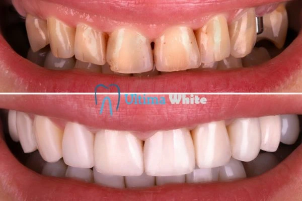 What Makes Instant Teeth Whitening Treatments So Popular Guildford?